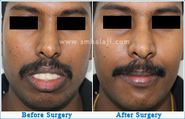 Face made more pleasant with corrective jaw surgery