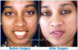 Facial appearance improved with corrective jaw surgery