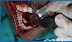 tori jaw surgically excised prosthetic dentoalveolar