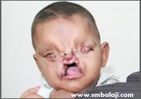 Tessier cleft deformity, before surgery