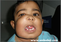 Child at 18 months of age with tumour in upper and lower jaw