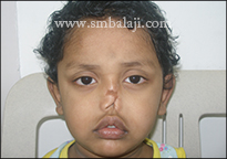 A boy's nose severy injured in an accident