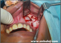 During Surgery Facial Fracture