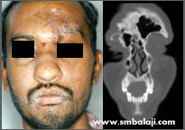 Forehead bone fracture, CBCT image of fracture