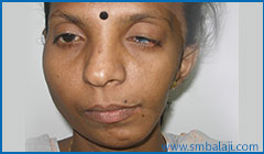 Asymmetrical face in a patient of hemifacial microsomia