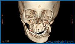 CT scan image before surgery showing facial asymmetry
