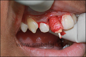 Fractured tooth removed with good support to the labial and palatal plates