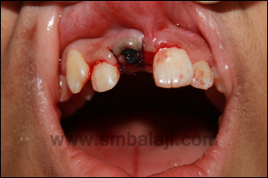 Immediate dental implant fixed into the extraction socket with good retention and stability