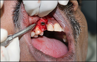  Immediate implant placed into the extraction socket with good stability and retention