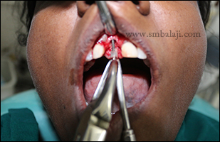 Retrieval of the failed implant without any damage to the supporting tooth structure