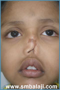A boy's nose severy injured in an accident