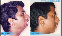 Lower jaw defect due to TMJ ankylosis
