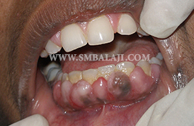 Periodontics-Management of Gum diseases, Balaji Dental, Chennai, India