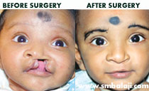 cleft lip surgery in India