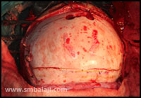 Craniotomy - opening the skull