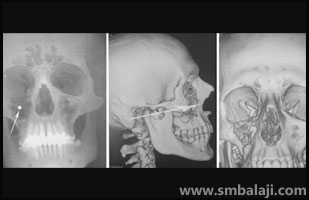 CT scan images showing extent of damage due to bullet injury