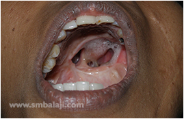 Palatal fistula following the trauma