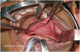 Temporalis myofascial flap used to close the defect