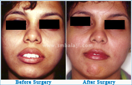 Corrective jaw surgery for large upper jaw affecting appearance