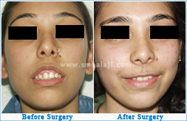 Excessively large upper jaw treated with corrective jaw surgery