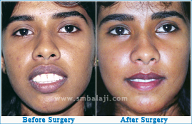 Facial profile enhanced with orthognathic surgery