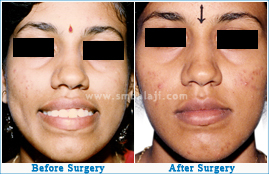 Orthognathic surgery for protruding upper jaw treatment
