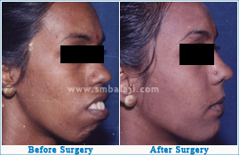 Profile and jaw disparity corrected with orthognathic surgery