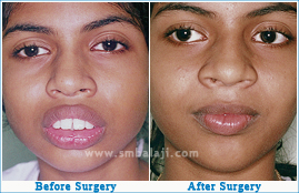 Severely protruding upper jaw corrected with orthognathic surgery