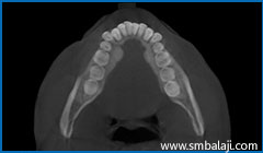 Mandibular tori