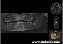 impacted lower right wisdom tooth