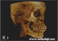 impacted tooth and cyst