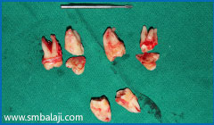 All impacted teeth removed