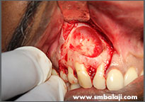 Bone defect cleaned after cyst removal