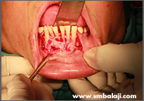 Bony lesion surgically exposed in the lower jaw 