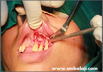 Bony lesion surgically exposed in the upper jaw 