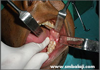 Clinical exposure of the diseased portion of the right lower jaw