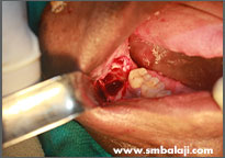Cyst lesion excised