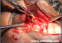 Cyst lesion surgically excised