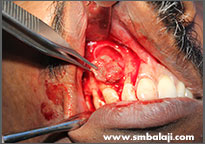 Cyst lesion surgically excised