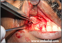 Cyst lesion surgically excised