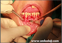 Cyst lesion surgically removed in lower jaw