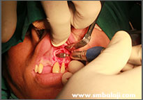 Cyst lesion surgically removed in upper jaw 