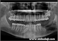 Digital X-ray taken immediately after surgery