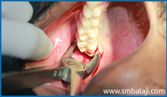 During extraction- Grasping the tooth with forceps