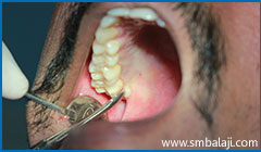 During extraction- accessing the tooth from the tongue side