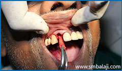Exodontia or tooth extraction