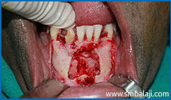 Immediately after surgical removal of impacted lower canine teeth