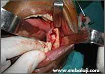 Impacted teeth and cyst excised surgically