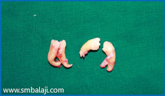 Impacted teeth surgically removed