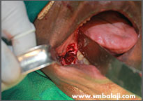 Impacted tooth surgically removed